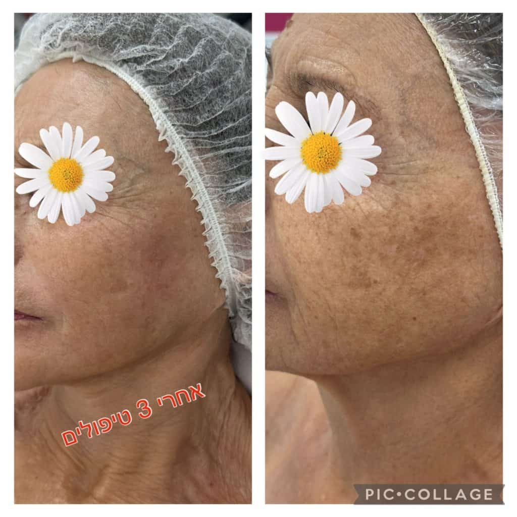 אחרי 3 טיפולים