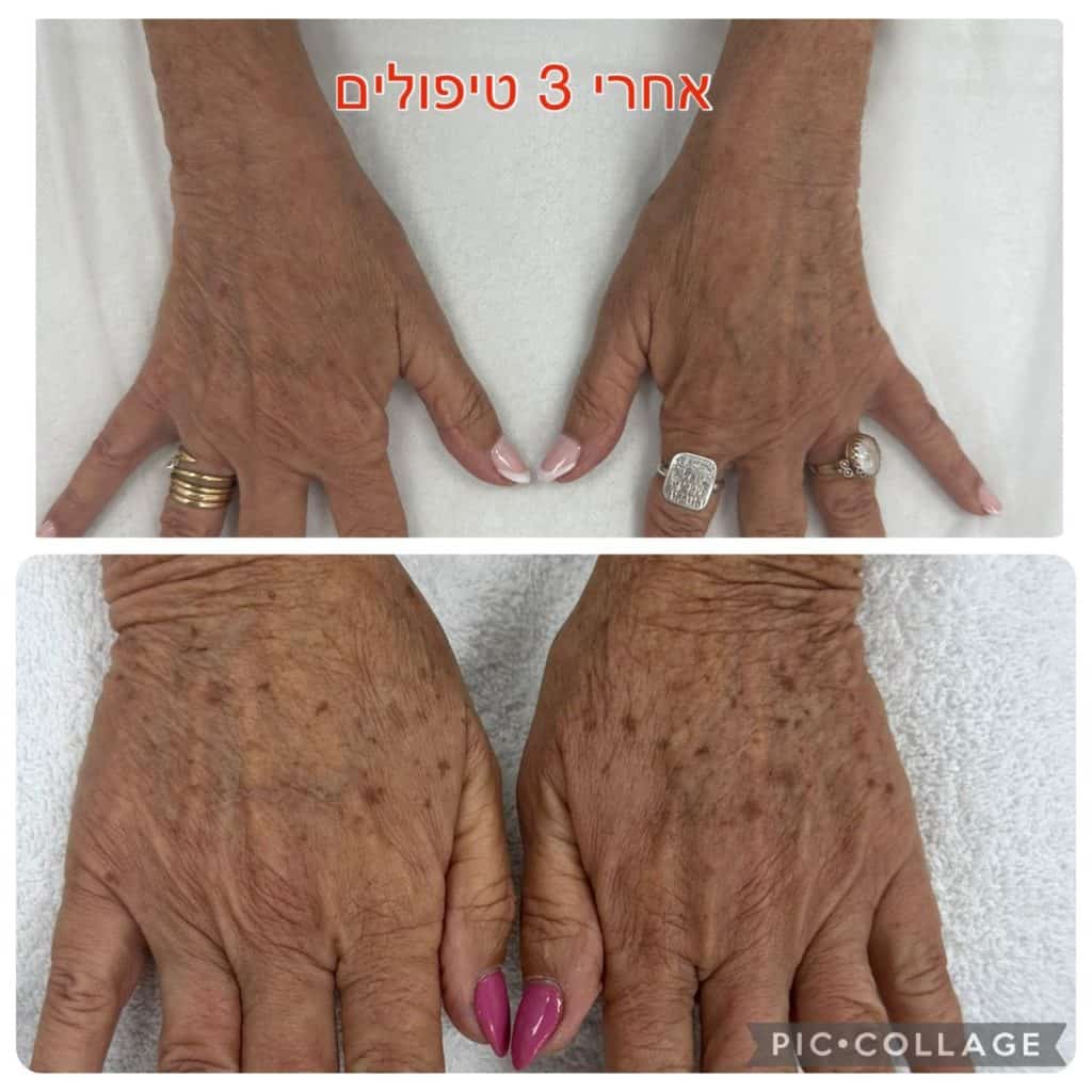 הסרת כתמים בידיים (1)