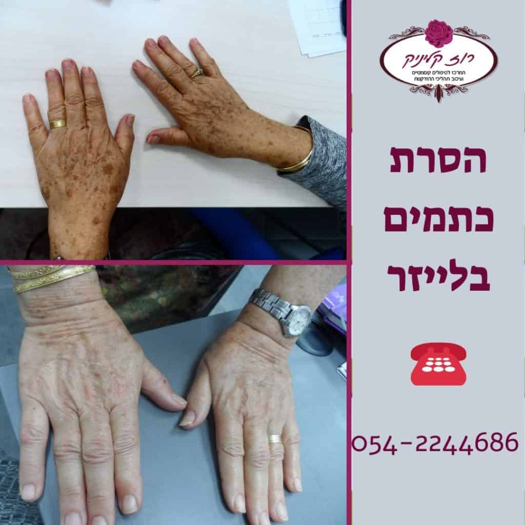 הסרת כתמים בידיים (3)