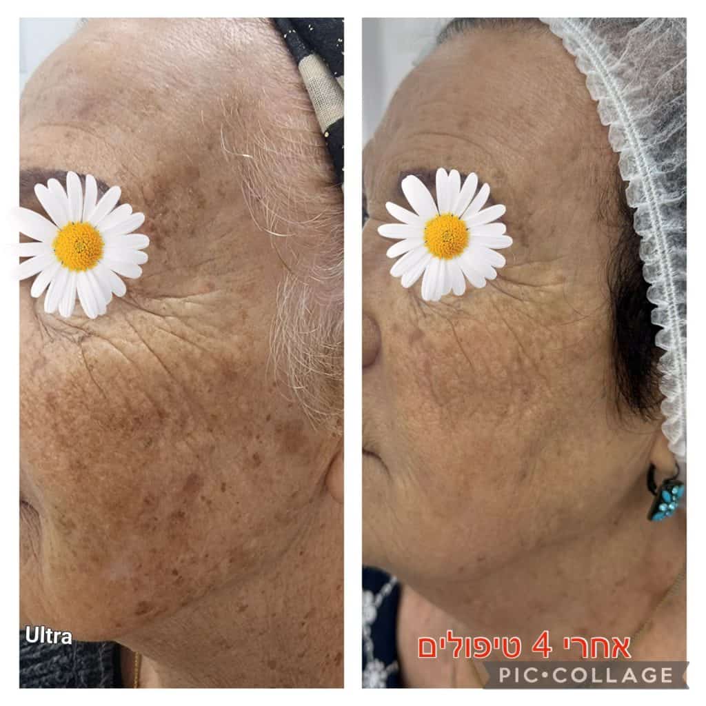 לפני אחרי טיפול פיגמנטציה לפנים