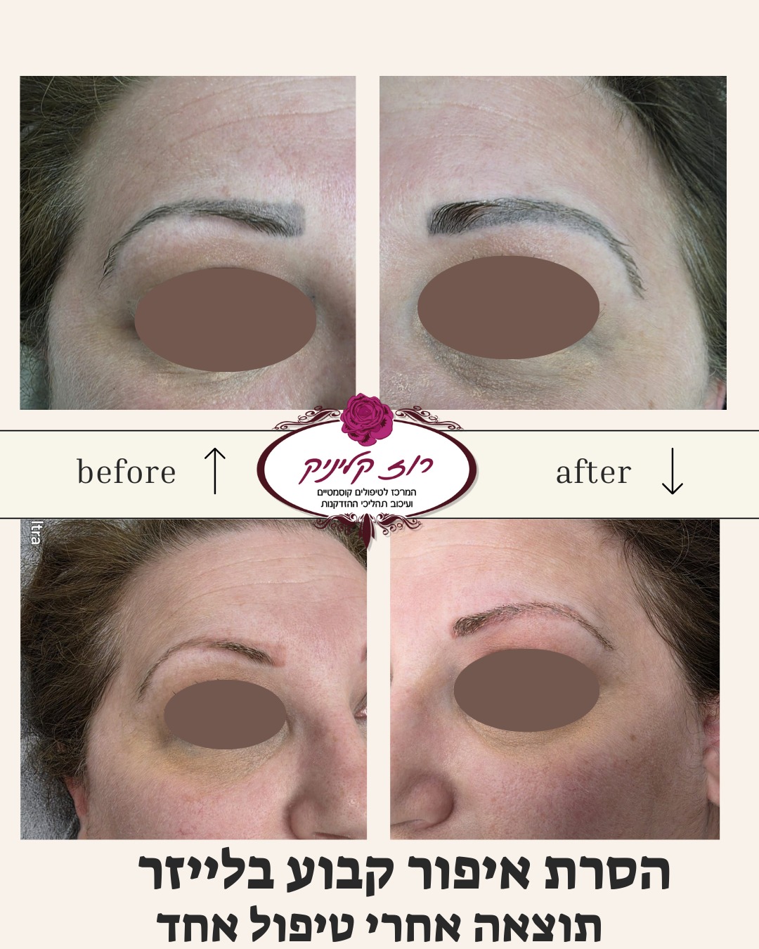 הסרת איפור קבוע בלייזר לפני אחרי (1)