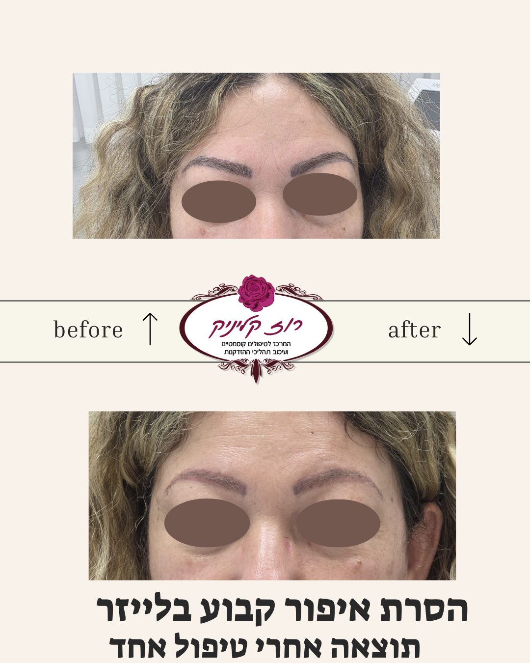 הסרת איפור קבוע בלייזר לפני אחרי (1)