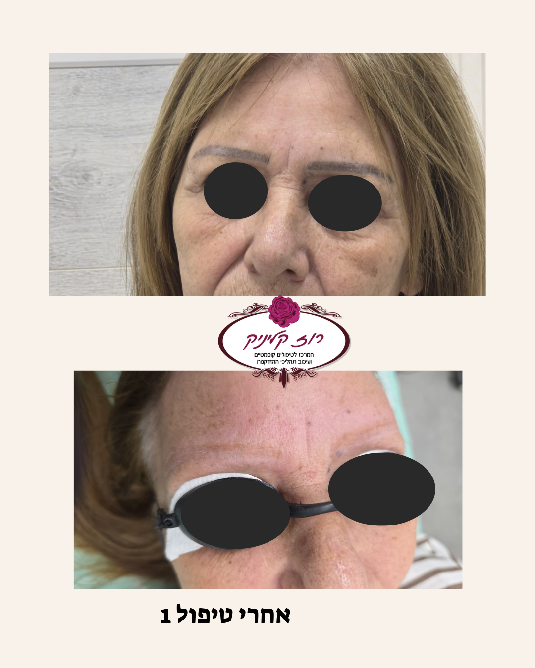 הסרת איפור קבוע בלייזר לפני אחרי (2)