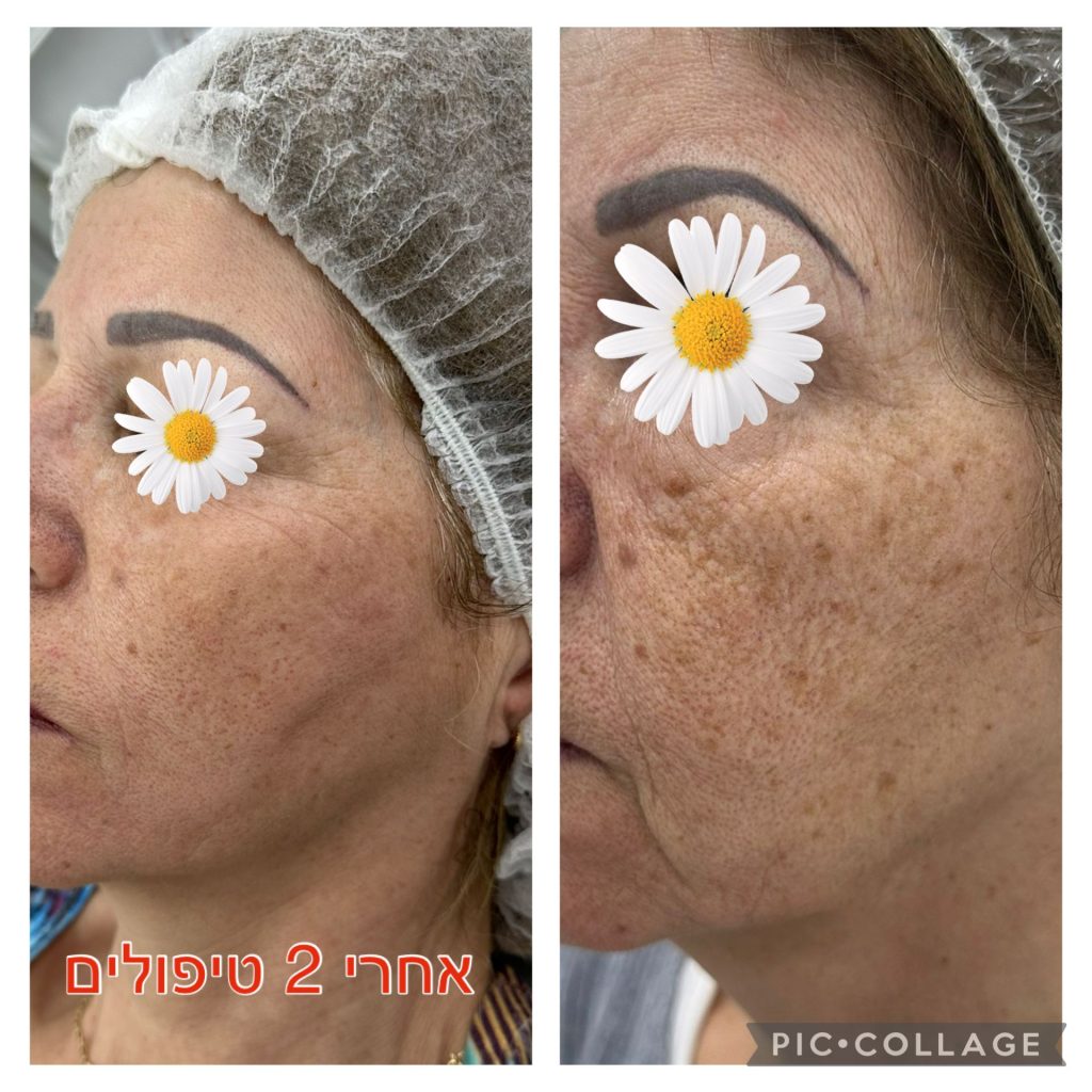 טיפול בקמטים לפני אחרי (1)