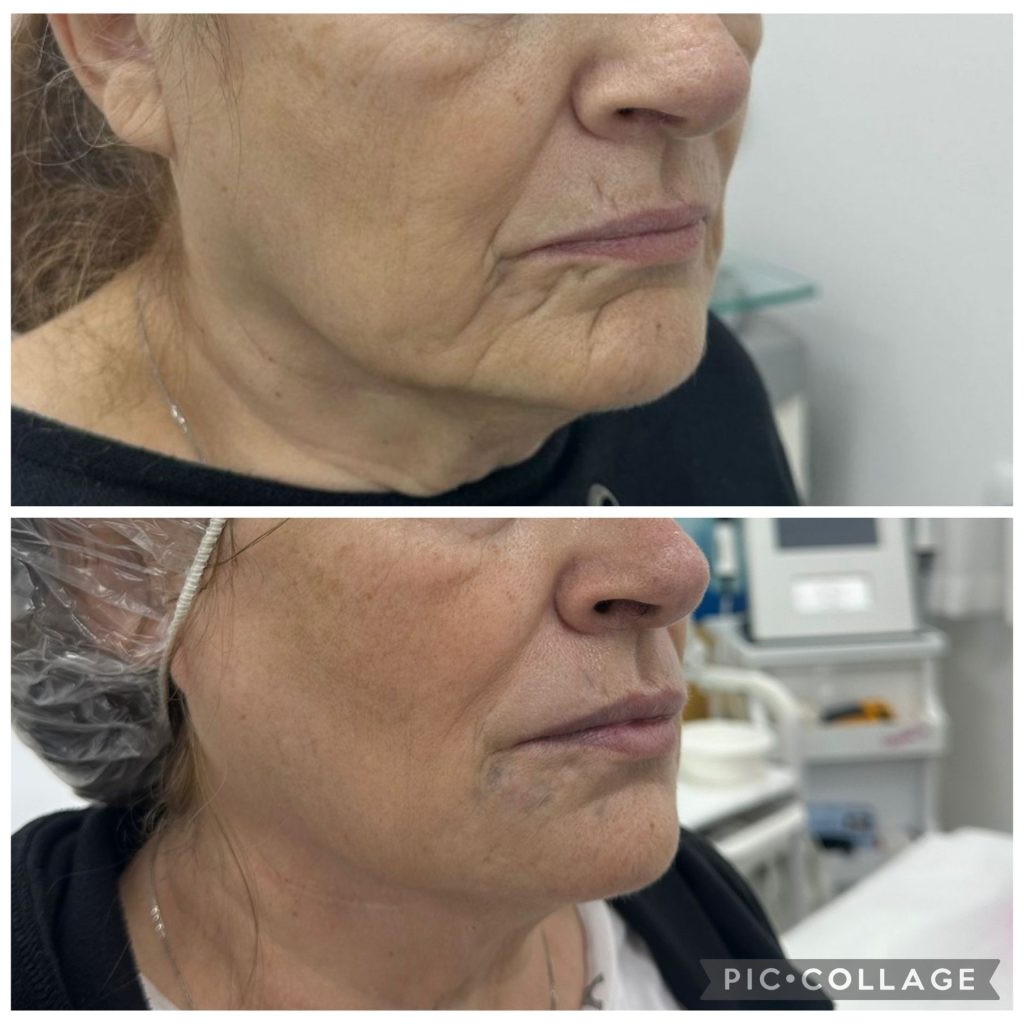 טיפול בקמטים לפני אחרי (3)