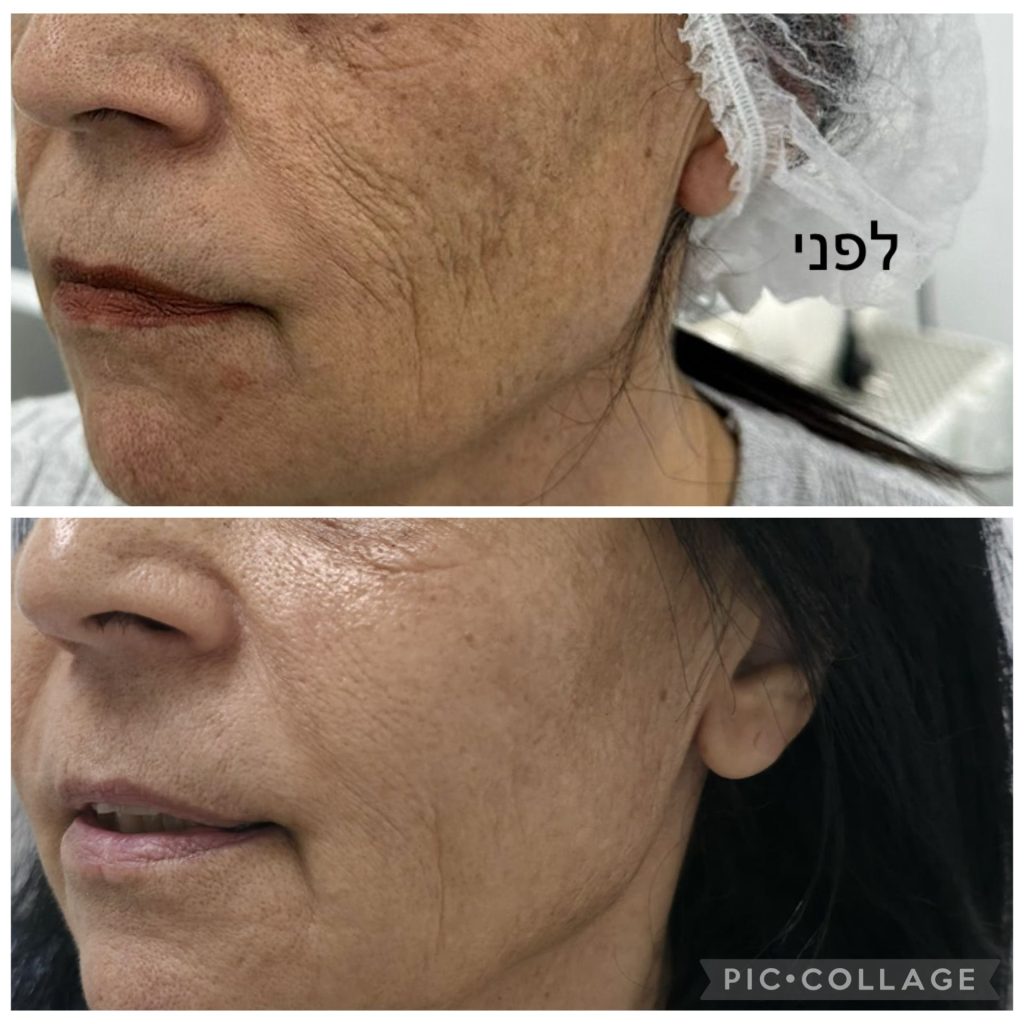 טיפול בקמטים לפני אחרי (4)